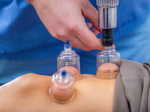 Wie wirkungsvoll ist Schröpfen bei Kniearthrose?